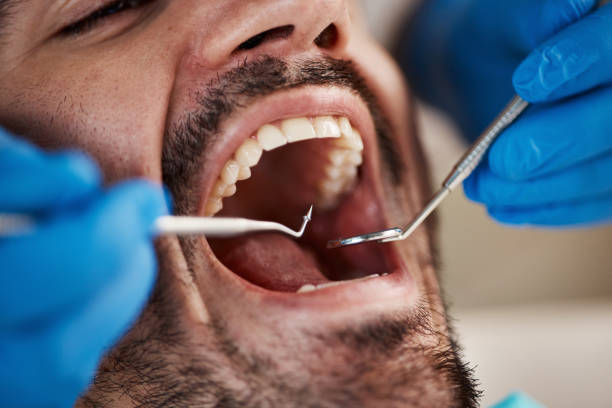 Best Emergency Wisdom Teeth Removal in Ashville, AL